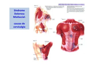 Síndrome
Dolorosa
Miofascial-
causas de
cervicalgia
 