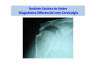 Tendinite Calcárea de Ombro
Diagnóstico Diferencial com Cervicalgia
 