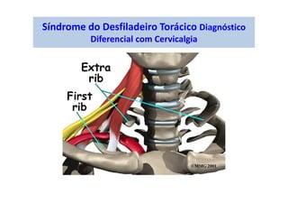 Síndrome do Desfiladeiro Torácico Diagnóstico
Diferencial com Cervicalgia
 