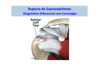Ruptura de Supraespinhoso
Diagnóstico Diferencial com Cervicalgia
 