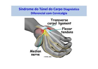 Síndrome do Túnel do Carpo Diagnóstico
Diferencial com Cervicalgia
 