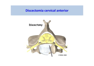 Discectomia cervical anterior
 