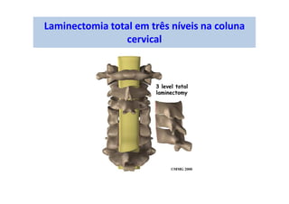 Laminectomia total em três níveis na coluna
cervical
 