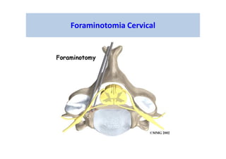 Foraminotomia Cervical
 