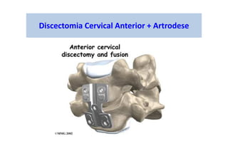 Discectomia Cervical Anterior + Artrodese
 