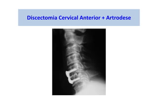 Discectomia Cervical Anterior + Artrodese
 