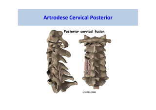 Artrodese Cervical Posterior
 