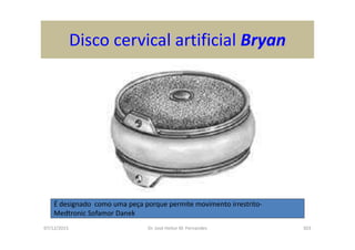 07/12/2015 Dr. José Heitor M. Fernandes 303
Disco cervical artificial Bryan
É designado como uma peça porque permite movimento irrestrito-
Medtronic Sofamor Danek
 