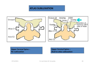 07/12/2015 Dr. José Heitor M. Fernandes 40
Upper Cervical Spine –
No subluxation
Upper Cervical Spine –
Skull to atlas subluxation
ATLAS SUBLUXATION
 