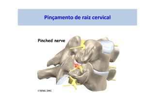 Pinçamento de raiz cervical
 