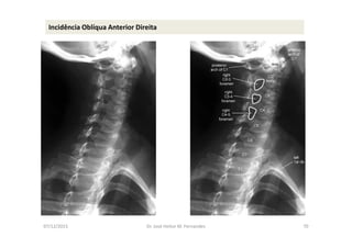 07/12/2015 Dr. José Heitor M. Fernandes 70
Incidência Oblíqua Anterior Direita
 