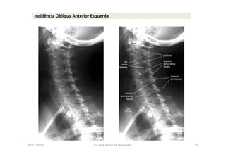 07/12/2015 Dr. José Heitor M. Fernandes 71
Incidência Oblíqua Anterior Esquerda
 