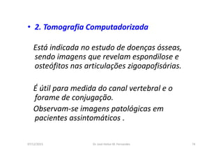 07/12/2015 Dr. José Heitor M. Fernandes 74
• 2. Tomografia Computadorizada
Está indicada no estudo de doenças ósseas,
sendo imagens que revelam espondilose e
osteófitos nas articulações zigoapofisárias.
É útil para medida do canal vertebral e o
forame de conjugação.
Observam-se imagens patológicas em
pacientes assintomáticos .
 