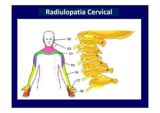 Radiulopatia Cervical
 