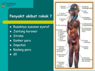 Penyakit akibat rokok ?
 Rusaknya susunan syaraf
 Jantung koroner
 Stroke
 Kanker paru
 Impoten
 Radang paru
 dll
 