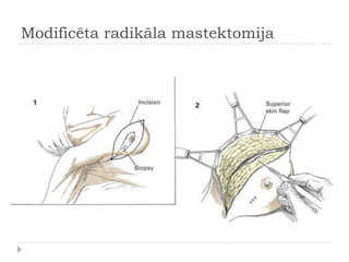 Modificēta radikāla mastektomija
 