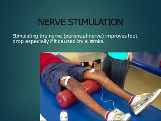 NERVE STIMULATION
Stimulating the nerve (peroneal nerve) improves foot
drop especially if it caused by a stroke.
 