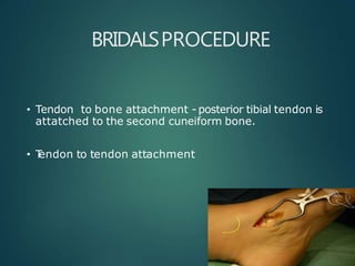BRIDALSPROCEDURE
• Tendon to bone attachment - posterior tibial tendon is
attatched to the second cuneiform bone.
• T
endon to tendon attachment
 