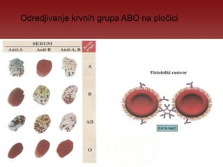 Odredjivanje krvnih grupa ABO na pločici 
 