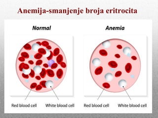 Anemija-smanjenje broja eritrocita
 