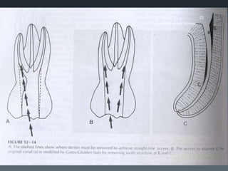 Access Cavity Prepration | PPTX