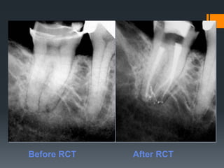 Access Cavity Prepration | PPTX