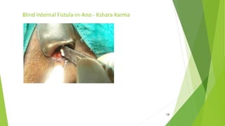 18
Blind Internal Fistula-in-Ano - Kshara Karma
 