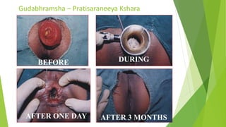 Gudabhramsha – Pratisaraneeya Kshara
108
rd
BEFORE DURING
AFTER ONE DAY AFTER 3 MONTHS
 