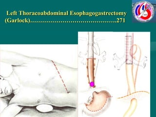 Left Thoracoabdominal Esophagogastrectomy
(Garlock)…………………………………….271
 