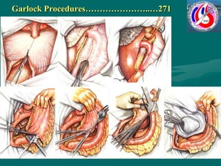 Garlock Procedures…………………..…271
 