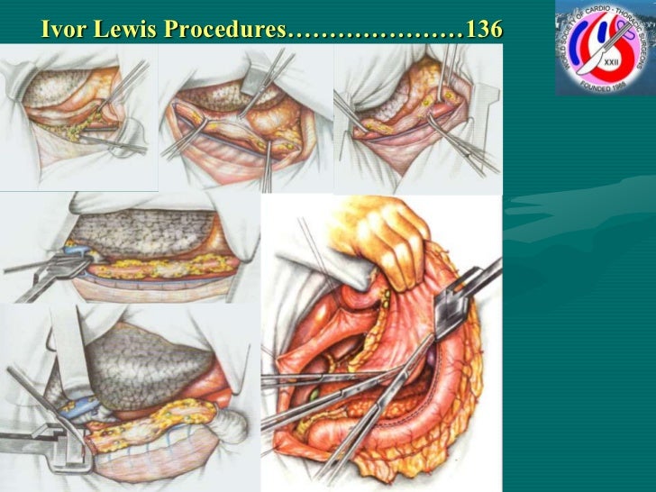 Kshivets O. Esophageal & Cardioesophageal Surgery