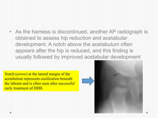 Developmental dysplasia of hip | PPTX
