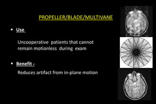 PROPELLER/BLADE/MULTIVANE
 Use -
Uncooperative patients that cannot
remain motionless during exam
 Benefit -
Reduces artifact from in-plane
motion
Other names for similar sequence
BLADE (Sie)
Reduces artifact from in-plane motion
 