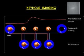 KEYHOLE -IMAGING
Arrival of contrast
injection
Fast dynamic
scanning
Reconstruction
ky
kz
ky
kz
ky
kz
ky
kz1 2 3
ky
kz
mask
 