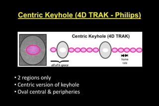 Centric Keyhole (4D TRAK - Philips)
• 2 regions only
• Centric version of keyhole
• Oval central & peripheries
 