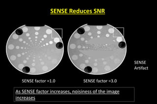 SENSE Reduces SNR
SENSE factor =1.0 SENSE factor =3.0
As SENSE factor increases, noisiness of the image
increases
SENSE
Artifact
 