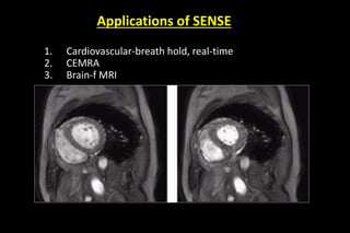 Applications of SENSE
1. Cardiovascular-breath hold, real-time
2. CEMRA
3. Brain-f MRI
 