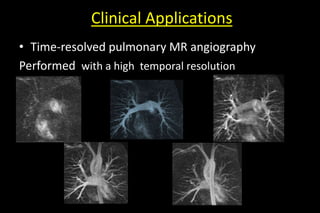 Clinical Applications
• Time-resolved pulmonary MR angiography
Performed with a high temporal resolution
 