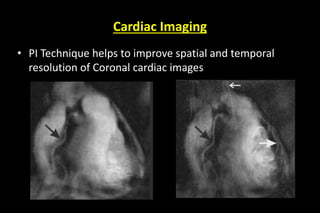 Cardiac Imaging
• PI Technique helps to improve spatial and temporal
resolution of Coronal cardiac images
 