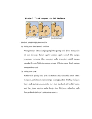 Gambar 3 : Teknik Menyusui yang Baik dan Benar
i. Masalah Menyusui pada masa nifas
1) Puting susu datar/ tertarik kedalam
Penanganannya adalah dengan pengurutan puting susu, posisi puting susu
ini akan menonjol keluar seperti keadaan seperti normal. Jika dengan
pengurutan posisinya tidak menonjol, usaha selanjutnya adalah dengan
memakai breast sbield atau dengan pompa ASI atau dapat ditarik dengan
menggunakan spoit.
2) Puting susu nyeri
Kebanyakan puting susu nyeri disebabkan oleh kesalahan dalam teknik
menyusui, yaitu tidak menyusu sampai kalang payudara. Bila bayi menyusu
hanya pada puting susunya, maka bayi akan mendapat ASI sedikit karena
gusi bayi tidak menekan pada daerah sinus laktiferus, sedangkan pada
ibunya akan terjadi nyeri pada puting susunya.
 