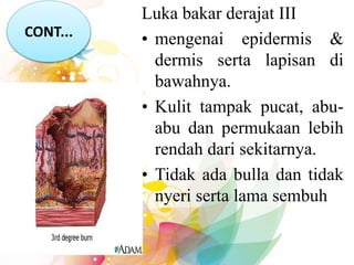 Luka bakar derajat III
• mengenai epidermis &
dermis serta lapisan di
bawahnya.
• Kulit tampak pucat, abu-
abu dan permukaan lebih
rendah dari sekitarnya.
• Tidak ada bulla dan tidak
nyeri serta lama sembuh
CONT...
 