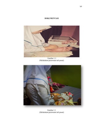 DOKUMENTASI
Gambar 1.1
(Melakukan perawatan tali pusat)
Gambar 1.1
(Melakukan perawatan tali pusat)
69
 