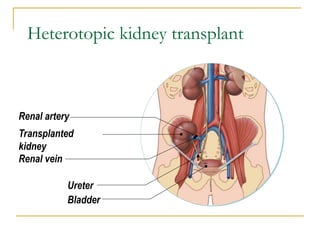 Heterotopic kidney transplant
Renal artery
Transplanted
kidney
Renal vein
Ureter
Bladder
 