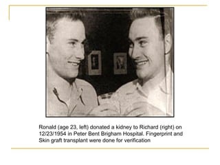 Ronald (age 23, left) donated a kidney to Richard (right) on
12/23/1954 in Peter Bent Brigham Hospital. Fingerprint and
Skin graft transplant were done for verification
 
