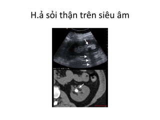 H.ả sỏi thận trên siêu âm
 