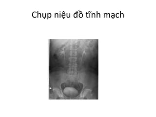 Chụp niệu đồ tĩnh mạch
 