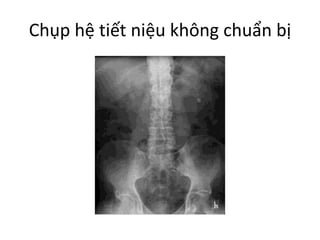 Chụp hệ tiết niệu không chuẩn bị
 