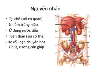 Nguyên nhân
• Tại chỗ (sỏi cơ quan)
- Nhiễm trùng niệu
- Ứ đọng nước tiểu
• Toàn thân (sỏi cơ thể)
- Do rối loạn chuyển hóa:
Gout, cường cận giáp
 