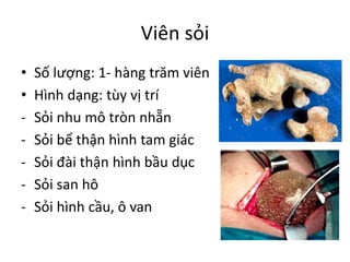 Viên sỏi
• Số lượng: 1- hàng trăm viên
• Hình dạng: tùy vị trí
- Sỏi nhu mô tròn nhẵn
- Sỏi bể thận hình tam giác
- Sỏi đài thận hình bầu dục
- Sỏi san hô
- Sỏi hình cầu, ô van
 