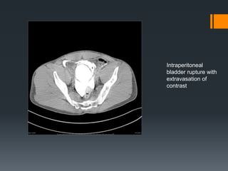 Kub - xray and usg | PPTX